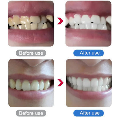 🦷🔥Bargain Alert ￡14.99!!⚡Electric Ultrasonic Dental Scaler | Remove Tartar & Plaque✨